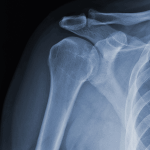 Shoulder X-Ray