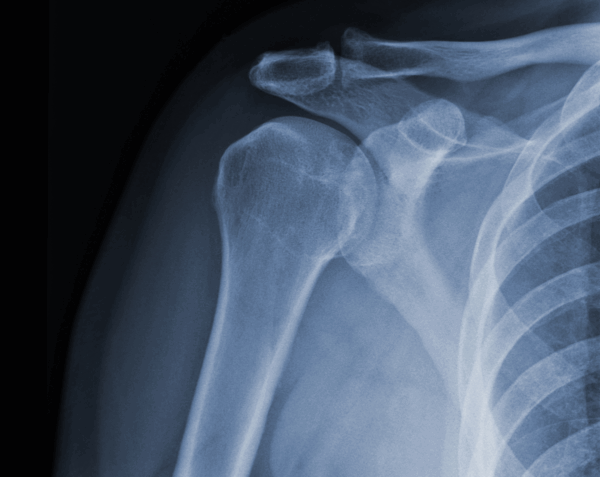 Shoulder X-Ray