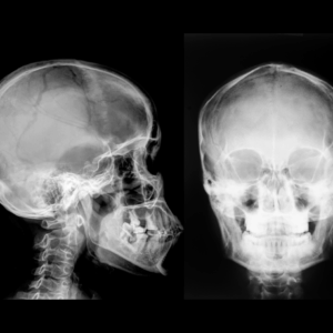 Skull X-Ray