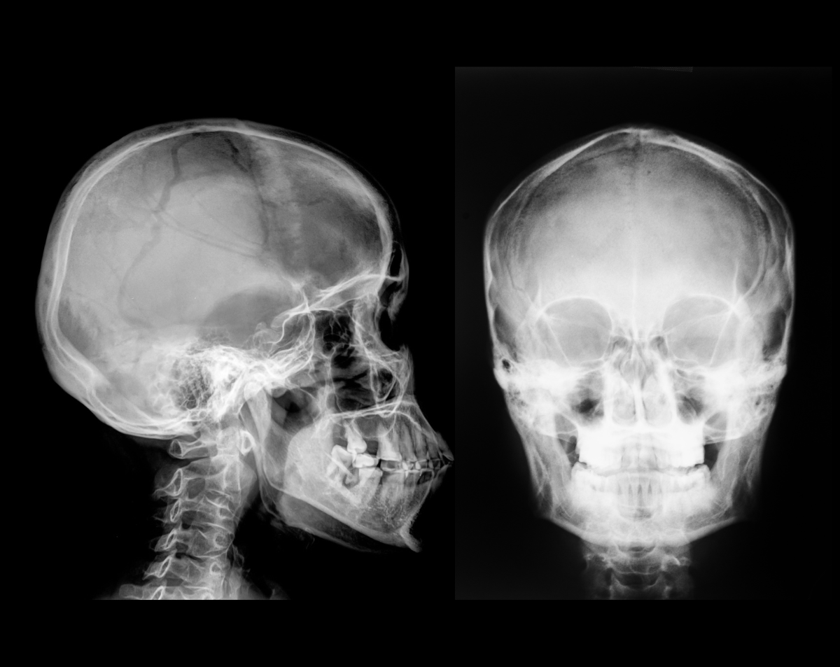 Skull X-Ray