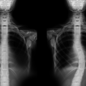Thoracic Spine X-Ray