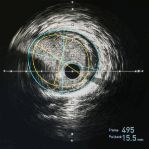 Ultrasound image showing a coronary artery with measurement overlays, relevant to cardiac testing services offered by Desert Mobile Medical.