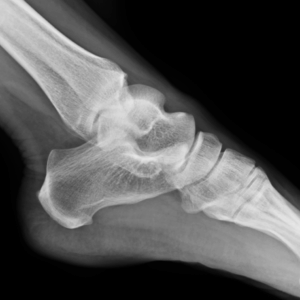 Left Ankle X-Ray