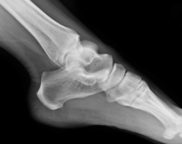 Left Ankle X-Ray