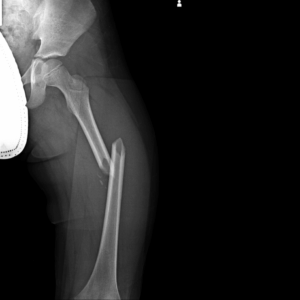Left Femur X-Ray