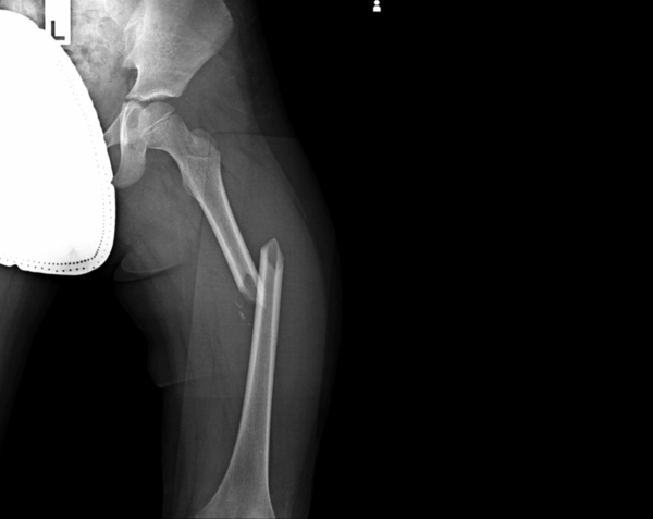 Left Femur X-Ray