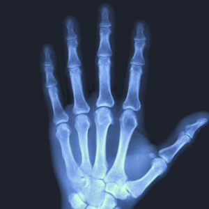 Left Fingers X-Ray