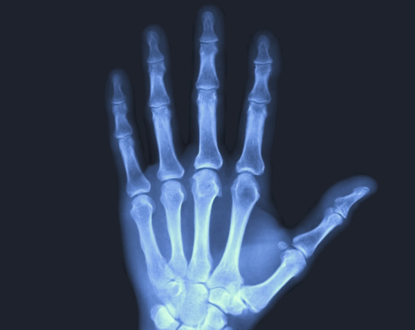 Left Fingers X-Ray