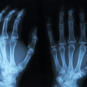 Left Hand X-Ray