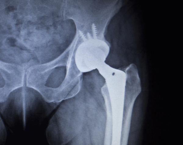 Left Hip X-Ray