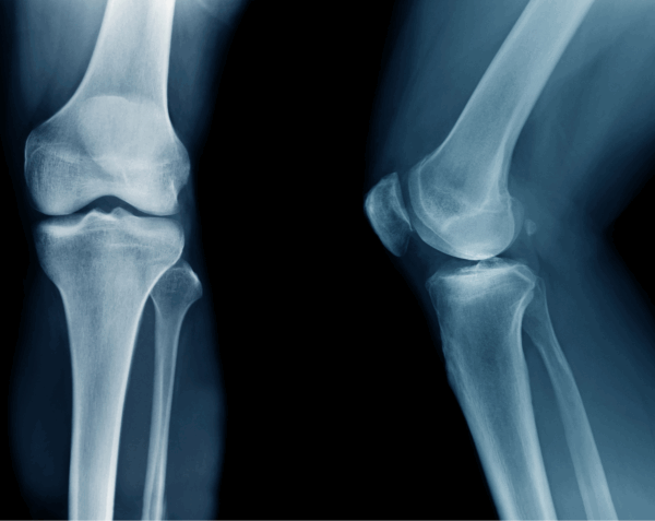 Left Knee X-Ray