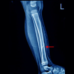 Left Tib/Fib X-Ray