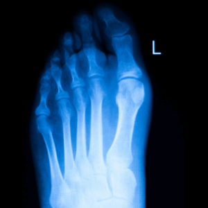 Left Toes X-Ray