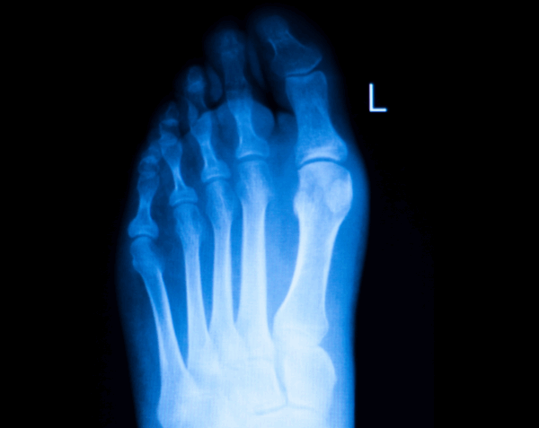 Left Toes X-Ray