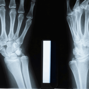 Left Wrist X-Ray