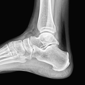Right Ankle X-Ray