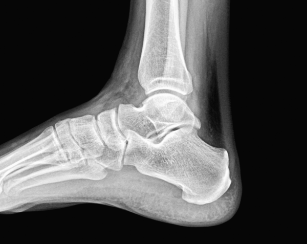 Right Ankle X-Ray