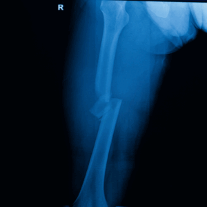 Right Femur X-Ray