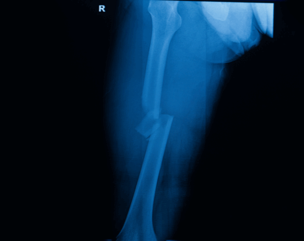 Right Femur X-Ray