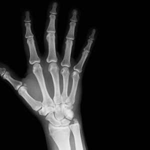 Right Fingers X-Ray