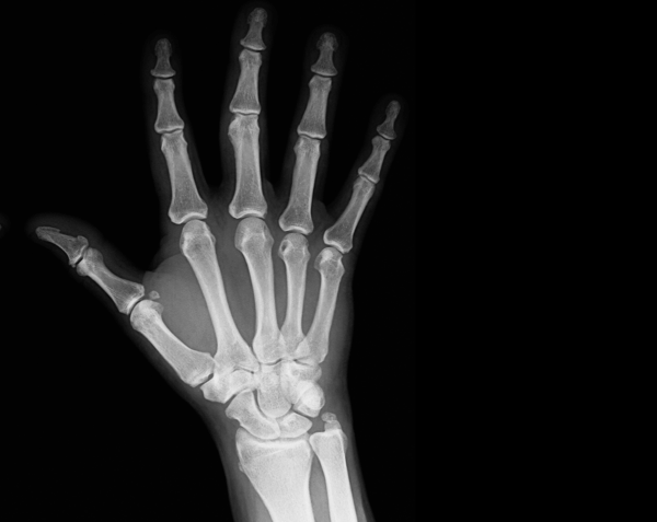 Right Fingers X-Ray
