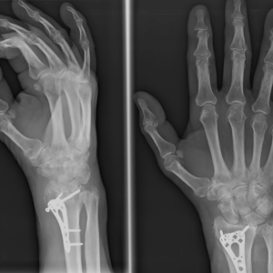 Right Hand X-Ray