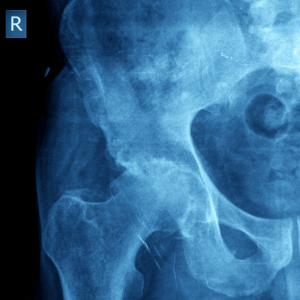 Right Hip X-Ray