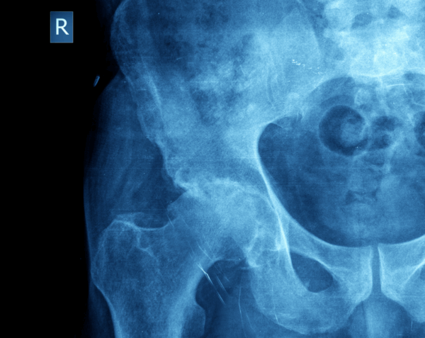 Right Hip X-Ray