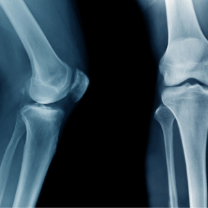 Right Knee X-Ray