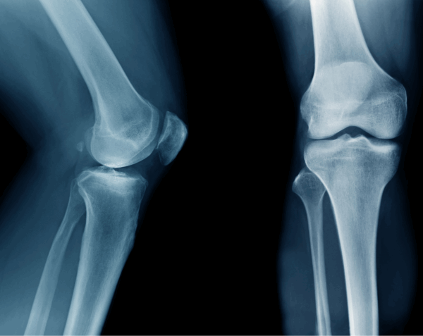 Right Knee X-Ray