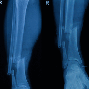 Right Tib/Fib X-Ray