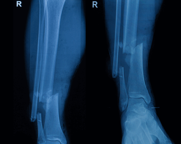 Right Tib/Fib X-Ray