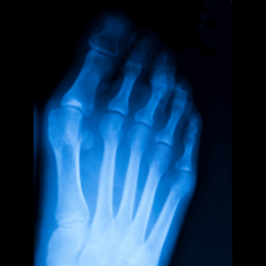 Right Toes X-Ray