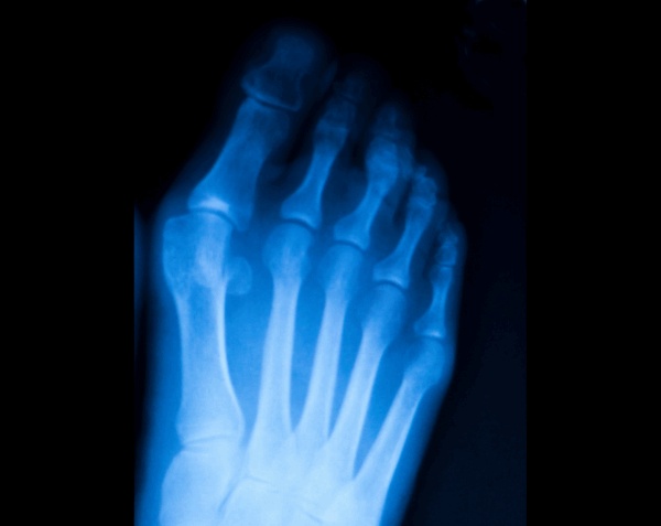 Right Toes X-Ray