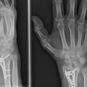 Right Wrist X-Ray