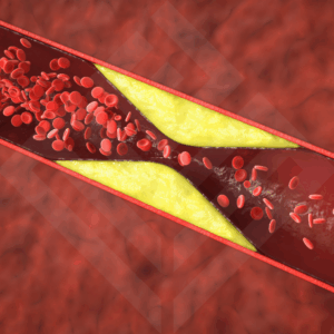 Coronary Artery Calcium Score