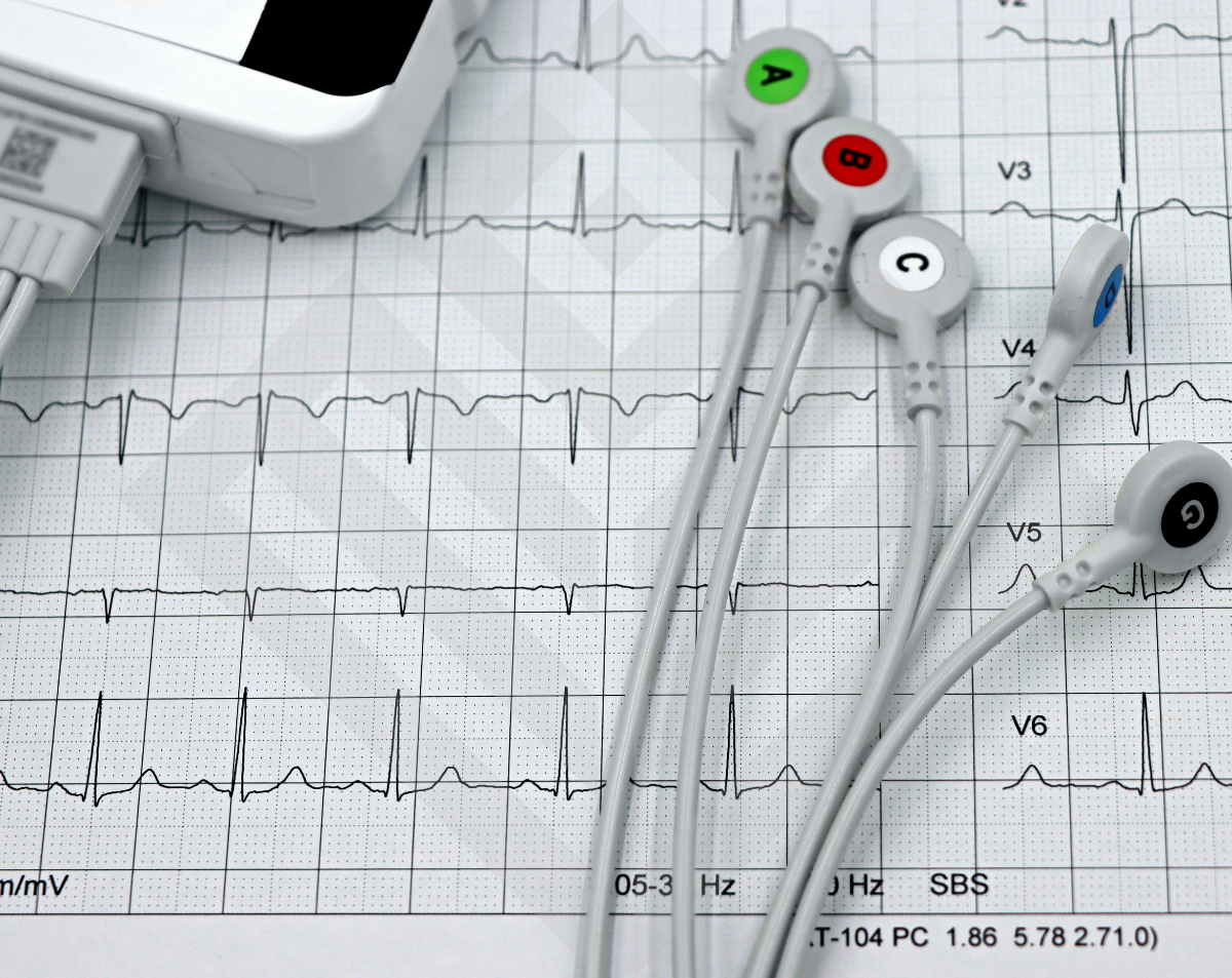 Electrocardiogram (EKG/ECG) Test