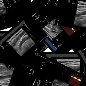 LE Venous Ultrasound